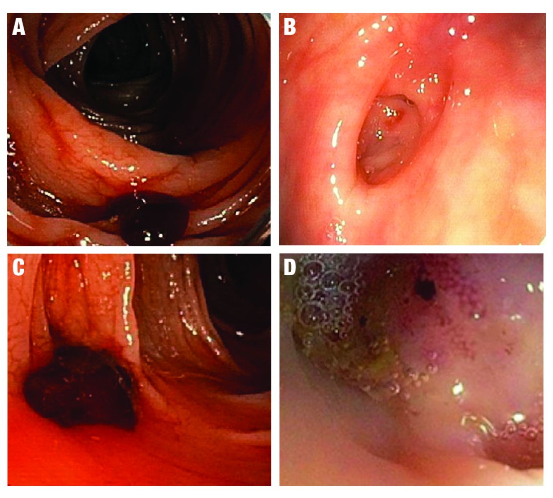 Figure: Stigmata of recent hemorrhage in definitive TIC hemorrhage is shown, as well as prevalence on urgent colonoscopy when diagnosed: A. Active arterial bleeding, 26%; B. Nonbleeding visible vessel, 24%; C. Adherent clot, 37%; D. Flat spot, 13%.
